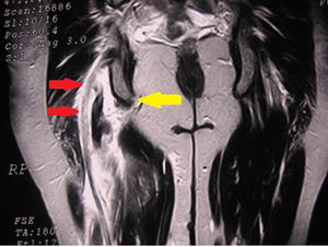 Imagen de RMN de un arrancamiento agudo del tendón conjunto de los IQT derechos, dejando vacía la tuberosidad isquiática (flecha amarilla). Obsérvese la proximidad del nervio ciático (flechas rojas).