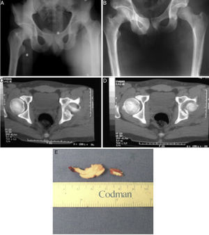 A) Radiografía AP de pelvis que muestra luxación de cadera izquierda. B) Reducción incongruente por fragmento intraarticular. C) y D) Imagen tomográfica que demuestra fragmento intraarticular en cadera izquierda. E) Fragmento osteoarticular extraído mediante artroscopia.