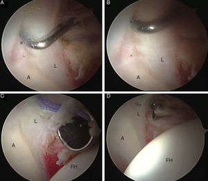 A) y B) Imágenes artroscópicas de lesión de labrum posterior y defecto condral acetabular (*) secundario a luxación traumática posterior de cadera izquierda. C) y D) Imágenes artroscópicas que demuestran la reparación labral con un anclaje y sutura, con el portal lateral para la lente de 70° y el portal anterior para la introducción de los instrumentos. A: acetábulo;CF: cabeza femoral; L: labrum.