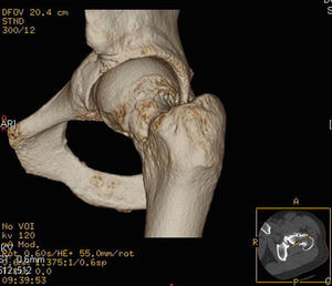 Reconstrución 3D a partir de imágenes de TAC de cadera izquierda. Las flechas señalan la lesión de tipo leva.