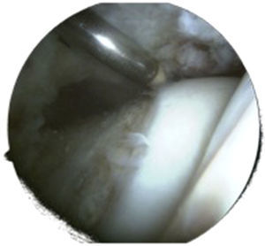 La técnica artroscópica no permite el uso de esferómetros para confirmar la correcta resección de la deformidad femoral. La imágen muestra la zona de transición cervicocefálica tras resección de la deformidad. Imagen de artroscopia de cadera izquierda con visión desde portal anterolateral sin tracción del compartimento periférico.