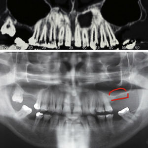 Posterior maxilla defect with hyperpneumatisation of the sinus and alveolar atrophy with a vertical component. CBCT and OPG scan with marking of the subsinusal and alveolar reconstruction area.