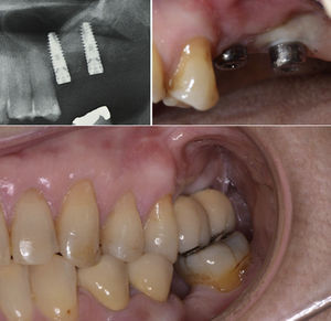 X-ray after 15 weeks following implant fixation. Gingiva formers and crowns.