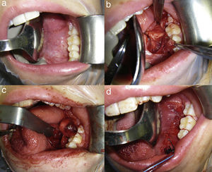 (a) Preparation of the lateral floor of the mouth for the intraoral approach with mouth-opener and tongue retractor. (b) Incision in the mouth floor showing the lingual nerve, Wharton's duct, and sublingual gland. (c) Image showing the submaxillary gland on the mouth floor just about to be removed. (d) Access closure with absorbable suture in two planes, with the drain fixed to patient's canine tooth.