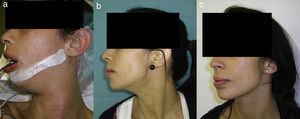 (a) Patient in the immediate postoperative period. (b) Image one week after the surgery; some mild haematoma is seen in the neck region. (c) Image one year after the surgery.