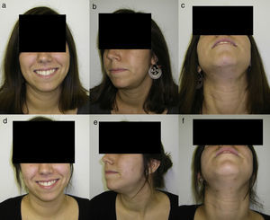 (a–c) The patient before surgery. (d–f) Image 1 year after surgery.3.