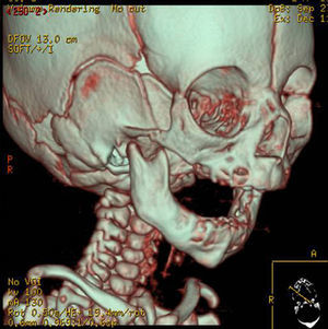 3D CT scan of patient with Treacher-Collins syndrome.