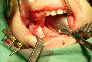 Intraoperative picture: osteotomy to place the distractor.