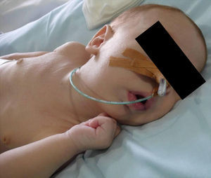 3.5 month-old patient with costal recession, undernourished, nasotracheal tube and nasogastric catheter.