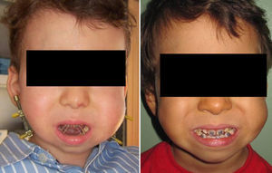 Left: patient with anterior open bite after bone distraction with brackets and elastic bands. Right: the same patient with close bite.