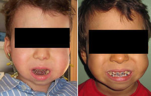 Left: patient with anterior open bite after bone distraction with brackets and elastic bands. Right: the same patient with close bite.