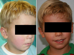 Left: patient in Fig. 3 at 3 years old. Right: patient in Fig. 3 at 5 years old.