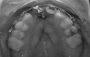 Patient no. 1: orthodontic preparation after bilateral secondary alveoloplasty.