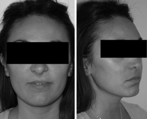 Patient no. 3: as of 8 years of follow-up after osteogenic distraction.