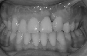 Patient no. 3: overjet and overbite maintained 8 years after the DO.