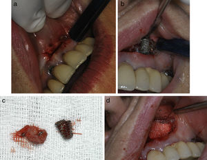 (a) “Apicoectomy” type approach through incision at oral vestibule level. (b) Exposure of peri-implant osteitis area and section of implant apical part to facilitate access. (c) Re-dried implant apical area and curettaged granulation tissue. (d) Bone filling (in this case with artificial bone).