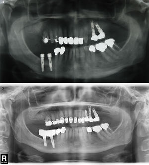 (a) Case number 4: presence of radiolucent area round the implant apex of more posterior mandibular implant. In this case, implant insertion was performed simultaneously with the lateralisation of the right inferior alveolar nerve. (b) Radiological control after periapical surgery without bone filling. Apex resection was necessary to access the entire osteitis area correctly.
