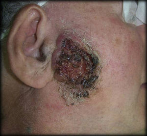 Basocellular carcinoma located in the preauricular area.