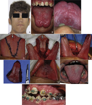 (A) Facial pattern III, with severe maxillary hypoplasia, (B, C) dental crowding and macroglossia, (D) incision demarcation, (E) tongue fragment excision, (F) after tongue fragment removal, (G) surgical piece, (H) suture, (I) 3-year postoperative period, and (J) orthodontic treatment after glossectomy that shows class III malocclusion with anterior open bite.