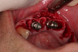 Post-extraction implants, always based on the lingual wall, 3mm below the apex, 3mm below the crest and 5mm from the contact point of the nearby tooth.