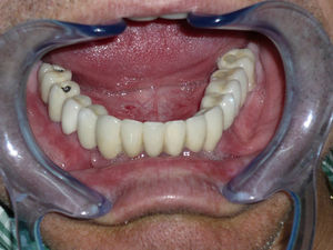 Final rehabilitation with screwed ceramo-metallic dentures.