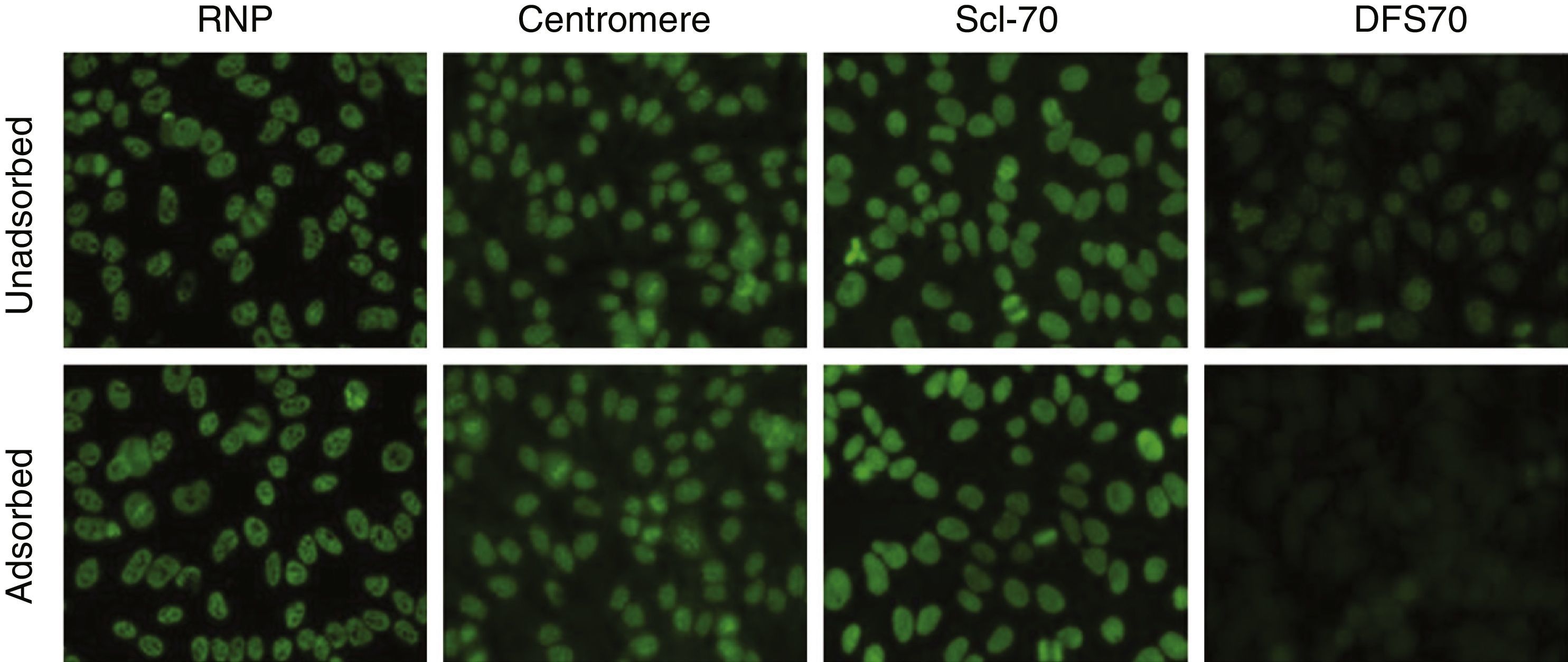 Importance of the dense fine speckled pattern and anti-DFS70 antibodies ...