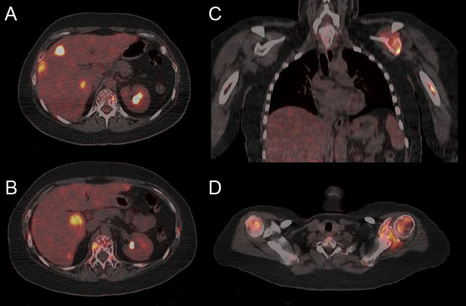 Whole-body 18F-FDG PET/CT in patients with multiple myeloma | Medicina ...