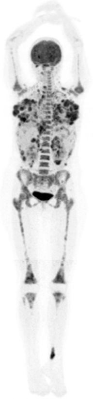 18F-FDG PET/CT in the staging of alveolar rhabdomyosarcoma | Medicina ...