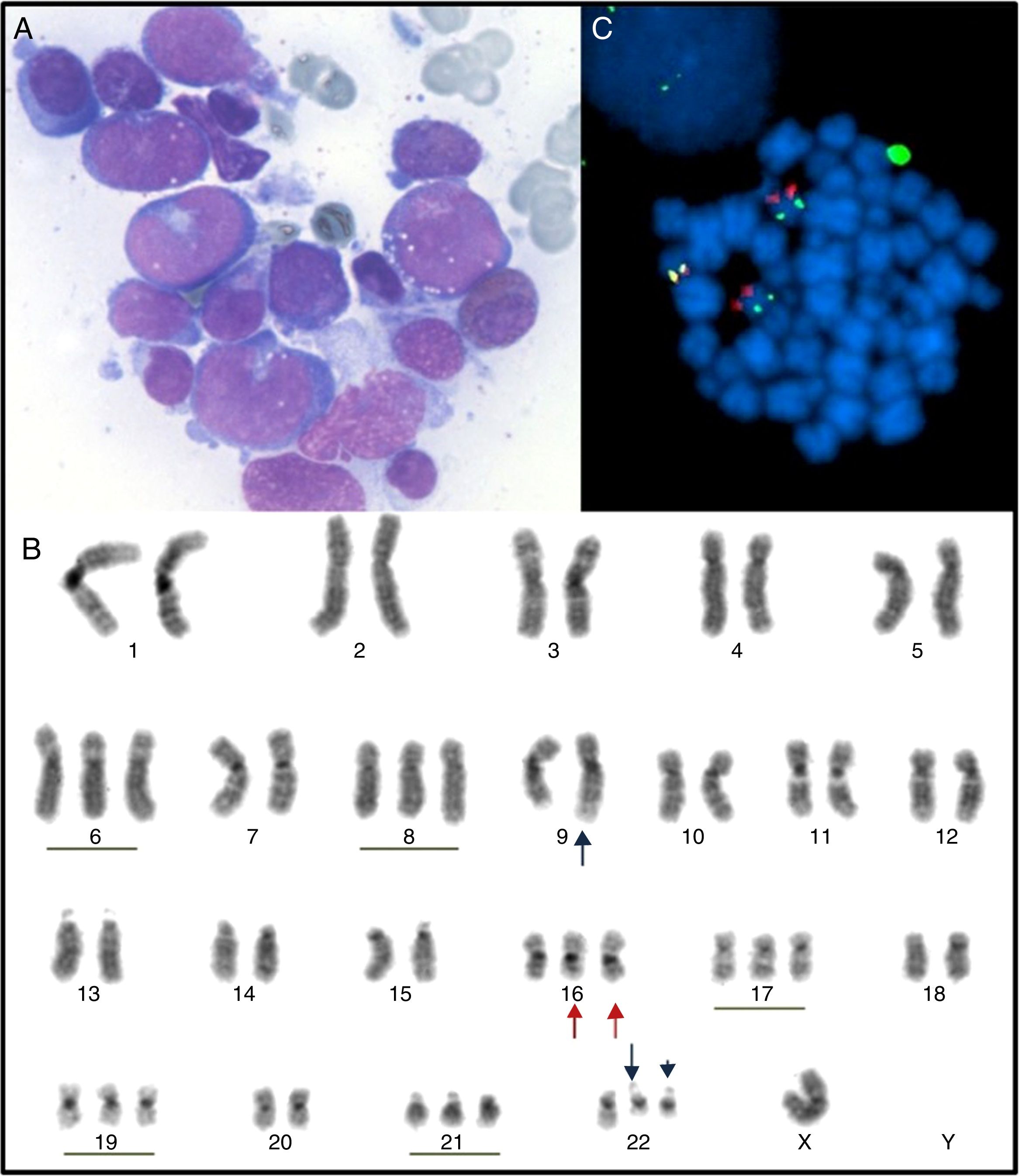 Inv16 Acquisition of Inv(16)(p13q22) in a blast crisis of chronic myeloid ...