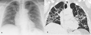 (A) CXR image. (B) CCT imaging, coronal reconstruction. COVID-19 positive patient. GGO are more easily identified on CCT imaging compared to CXR.