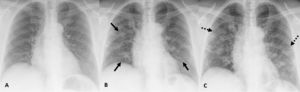 (A) CXR image of a 75-year-old patient who came to the emergency department and presented with 1-day history of COVID-19 infection-compatible symptoms without initial radiographic abnormalities and with a positive PCR result for SARS-CoV-2. (B) CXR image, 4 days later, in which bilateral GGO are identified. (C) CXR image, 2 days later, in which a reticular pattern is observed due to septal thickening with persistence of GGO.