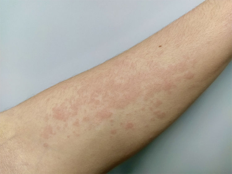 maculopapular rash pictures