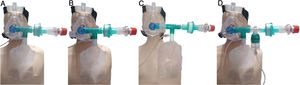 Diagram of the different options related to the oxygenation device with reservoir and PEEP (ODRPEEP). A: It consists of an appropriately sized, one-piece "T-shaped" NIV mask with closed elbow connected to a reservoir bag with its 15 L/min oxygen connection, a filter for bacteria and viruses with a filtering efficiency of > 99.99 % and a PEEP valve. The necessary inspiration volume will be made from the reservoir bag while the patient's expiration is done through the PEEP valve with an antibacterial and viral filter. B: In the case of needing to administer inhaled drugs, we use the pressurized cartridge fitting, needing an O2 extension end for its connection which we will snap into one of the holes in the mask. C: We can apply an inhaled drug without nebulization. We will use the diagram of option «a» adding a T-fitting for a pressurized cartridge between the elbow and the T of the reservoir bag. D: It will allow us to nebulize reducing the risk of aerosol leaks. We will use the diagram of option «a» adding a T-piece with a nebulization cup and extension. Without nebulization, we will provide the reservoir with a flow of 15 L/min and during nebulization, the flow must be distributed between the reservoir and the nebulizer cup to avoid hyperoxygenation.