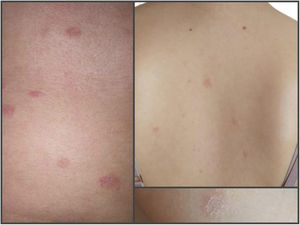 The image shows a rash consisting of 0.3 to 1.5 cm in diameter round and oval erythematous scaly plaques with peripheral collarette scaling.