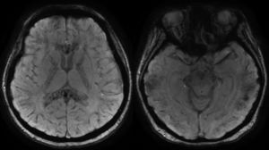 Brain MRI in magnetic susceptibility sequences. Multiple microbleeds can be seen that affect both the supra- and infra-tentorial compartments, located more superficially at the cortical-subcortical junction and deep, with more significant involvement, of the corpus callosum, internal capsules, and anterior white commissure. These findings suggest diffuse axonal injury.