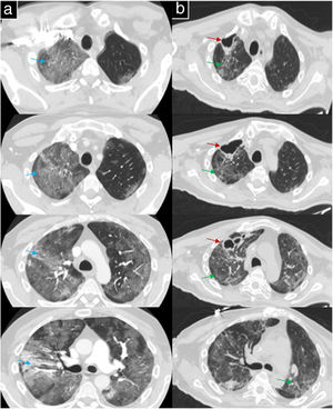 a) CT angiography with extensive areas of ground-glass opacities as well as areas with a tendency to consolidate and an air bronchogram in the right upper lobe (RUB) (blue arrows); b) high-resolution computed tomography with several thin-walled cystic images, with the largest being a multi-layered 4.5 cm T axis × 2.3 cm AP axis (red arrows) cyst. All of them located in the apical segment of RUL. In addition, ground glass involvement is identified with some areas of interlobular septal thickening in relation to cobblestone involvement and traction bronchiectasis, mainly in the anterior segment of the RUL (green arrows).