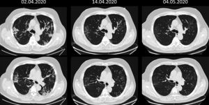 Coronal sequence at two levels of the chest CT scan before and after stem-cell therapy, showing normal conditions one month after cell therapy.