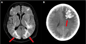 (A) Axial fluid-attenuated inversion recovery (FLAIR) MRI sequence showing bilateral, subcortical, hyperintense lesions with vasogenic edema in the parieto-occipital cerebral lobes (red arrows). (B) Cranial CT showing a large, left, frontal hematoma causing midline deviation (red arrow).