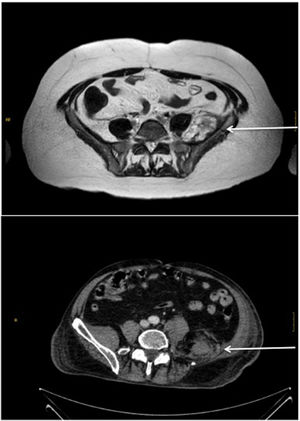Top: Nuclear magnetic resonance scan. Patient 1. Subacute hematoma in the iliacus muscle, with cranial progression over the psoas major muscle and significant anterior pararenal and axial deviation, measuring 84 mm (craniocaudal [CC]) × 64 mm (anteroposterior [AP]) × 43 mm (transversal [TR]). Bottom: Computerized axial tomography scan. Patient 3. Subacute intramuscular hematoma in the left psoas major and iliacus muscles, measuring 100 mm (CC) × 90 mm (AP) × 70 mm (TR).