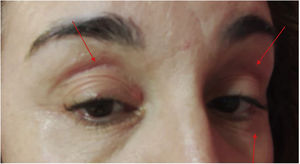 Non-scaling, red-wine coloured upper and lower eyelid erythema.