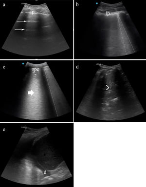 Lung ultrasound in patients with COVID-19 and lung score. (a) A lines: pattern of horizontal (thin arrow) lines parallel to pleura (p). (b) Focal B lines. Pattern of vertical lines that reach the depth of field ant start from the pleura line (dashed line). The pleural line is fragmented, like irregular pleura (ip). (c) Confluent B lines. In the form of a “white lung” (thick arrow) the B lines (dashed line) converge. The pleural line increases her irregularity, generating a subpleural consolidation (spc). (d) If the subpleural consolidation progresses, or in superinfection cases, translobar consolidations appear (arrowhead), achiving a look liver tissue-like. Pleural effusion could appear in severe cases (d). Lung score: We summed every area's points, obtaining the patient's lung score, ranging from 0 to 33. *: Irregular pleural lines and focal B lines=1 point, **: Confluent B lines=2 point, ***: Subpleural or lobar consolidation or pleural effusion=3 points.