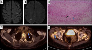 A and B) Diffusion-weighted MRI scan showing numerous dot-like lesions in the cortical and subcortical regions of both cerebral hemispheres. C) Temporal artery biopsy: disruption of the internal elastic membrane (arrow) and multinucleated giant cell to the right (triangle). D and E) PET/CT scan: 18FDG uptake in the supraaortic trunks and hips (arrows).