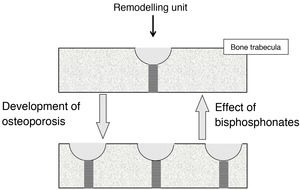 Development of osteoporosis: increase in remodelling units and, therefore, in reversible bone loss spaces (represented by crescents) and stress concentrators (represented by striped areas). Effect of bisphosphonates: opposing phenomena. Bone balance behaviour is not represented.
