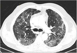 Coronal reconstruction of chest CT (lung window) with bilateral interstitial involvement and predominantly peripheral septal thickening associated with increased ground glass opacities.