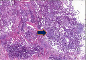 Lung cryobiopsy (HE 20×) showing chronic interstitial inflammation and alveolar invasion with immature collagen plugs or «Masson bodies» (arrow).