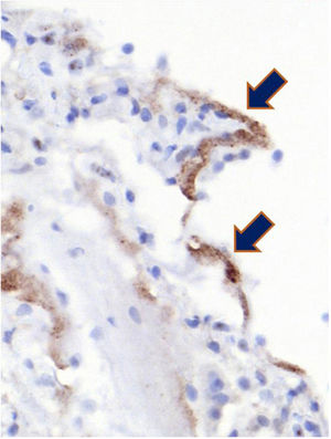 Immunohistochemical staining positive for SARS-Co-V2 in hyaline membranes.