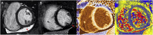Example of cardiac magnetic resonance in a patient with COVID-19 myocarditis. Pericardial effusion (A, arrow) is observed in CINE SSFP sequences, subepicardial delayed enhancement in the mid inferolateral segment (B, arrow) and increased T1 values in native mapping (C) and T2 values in mapping (D).
