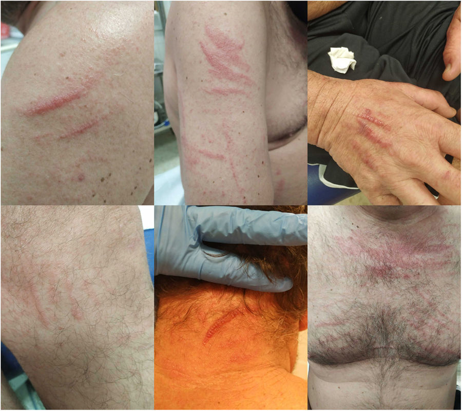 Flagellate dermatitis | Medicina Clínica (English Edition)