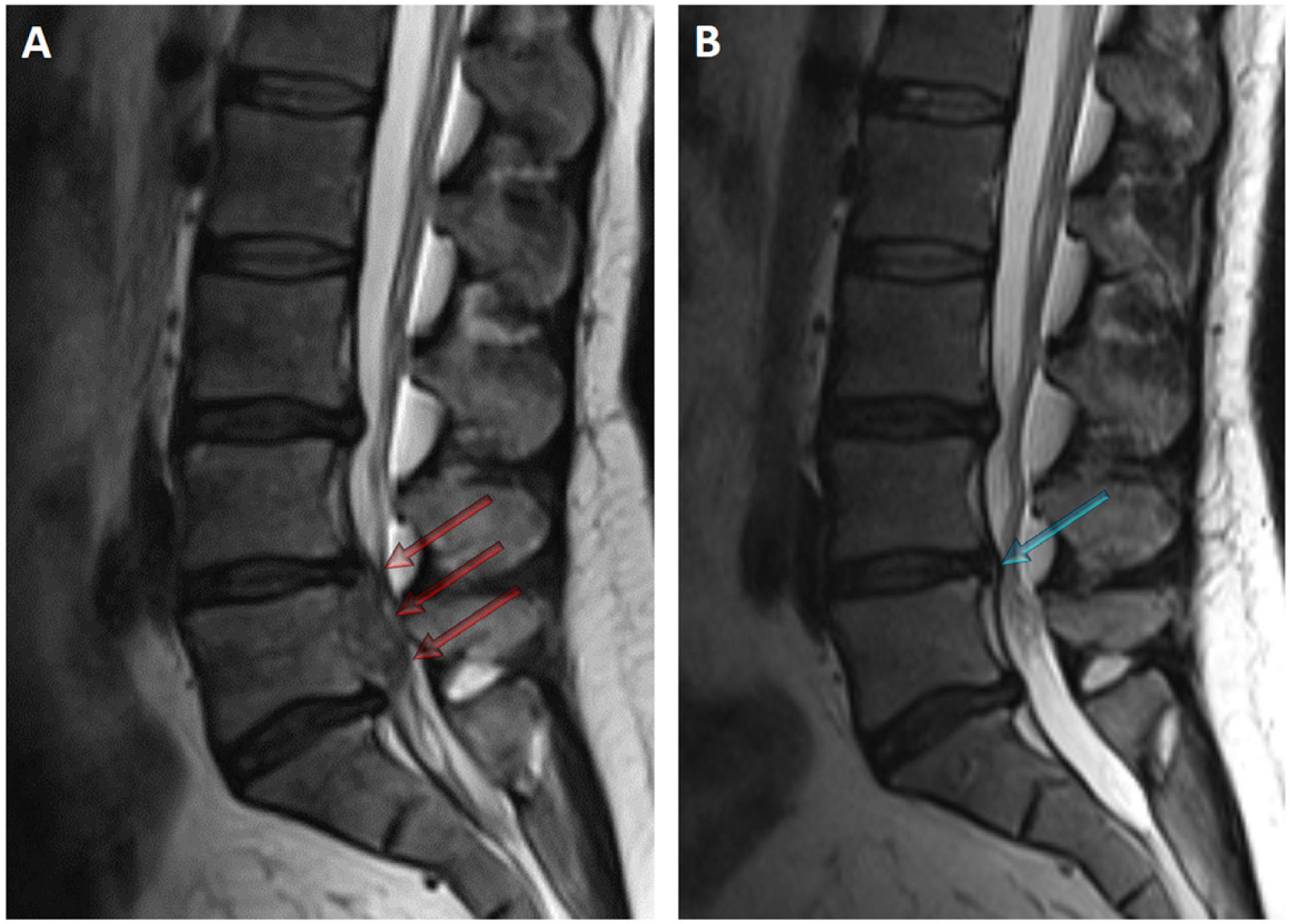 Spontaneous resolution of lumbar disc herniation | Medicina Clínica ...