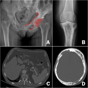 Radiological images of Paget's disease of bone. A) Involvement of the left hemipelvis, with alternating osteolytic and osteoblastic images and thickening of the cortices, *iliopectineal line, ** ilioischial line, *** acetabulum. B) Involvement of the upper tibia, with significant cortical thickening and alteration of bone trabeculae in the upper regions. C) Involvement of the thoracic vertebrae on pulmonary computed axial tomography, highlighting the alteration of the structure of the vertebral body. D) Cranial involvement in cranial computed axial tomography requested for stroke. Significant cortical thickening.